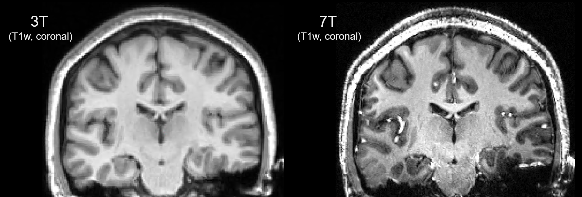 T1_3T7T_coronal